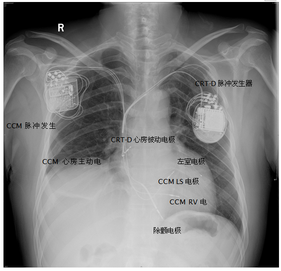 图3 crt-d及ccm植入患者术后胸片
