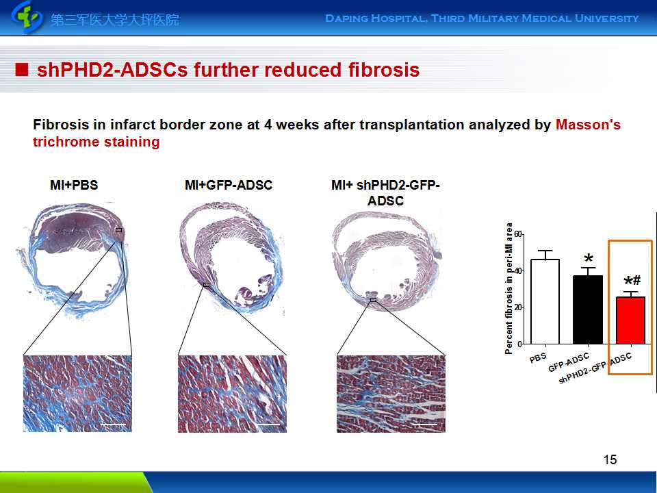 cerebral infarction,cerebral effect of stem cell therapy for myocardial infarction