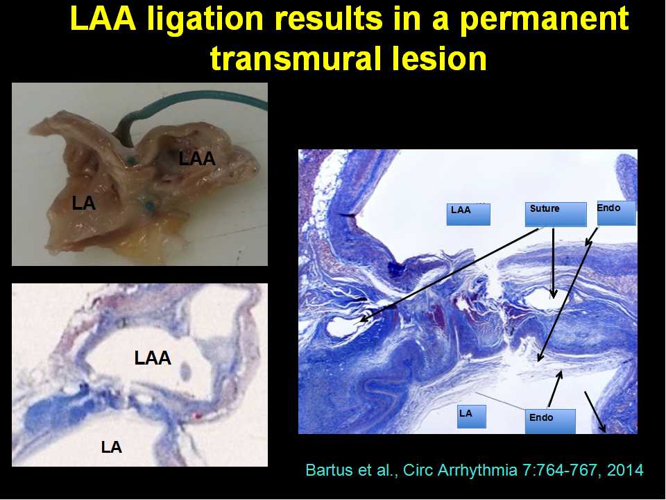 appendage,junco left atrial appendage closure using the lariat suture delivery