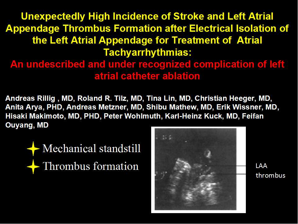 left atrial appendage closure using the lariat suture delivery