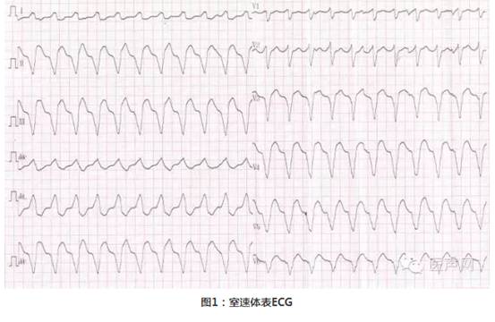 三维标测指导下持续3年无休止室性心动过速导管消融治疗1例