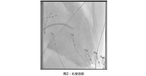 三维标测指导下持续3年无休止室性心动过速导管消融治疗1例