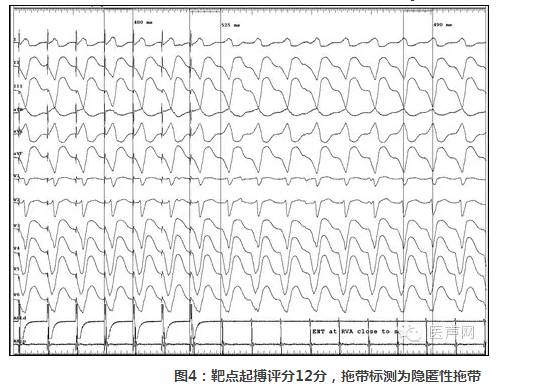 三维标测指导下持续3年无休止室性心动过速导管消融治疗1例