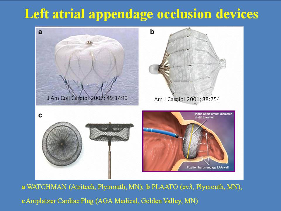 appendage,junco percutaneous left atrial appendage ligation with