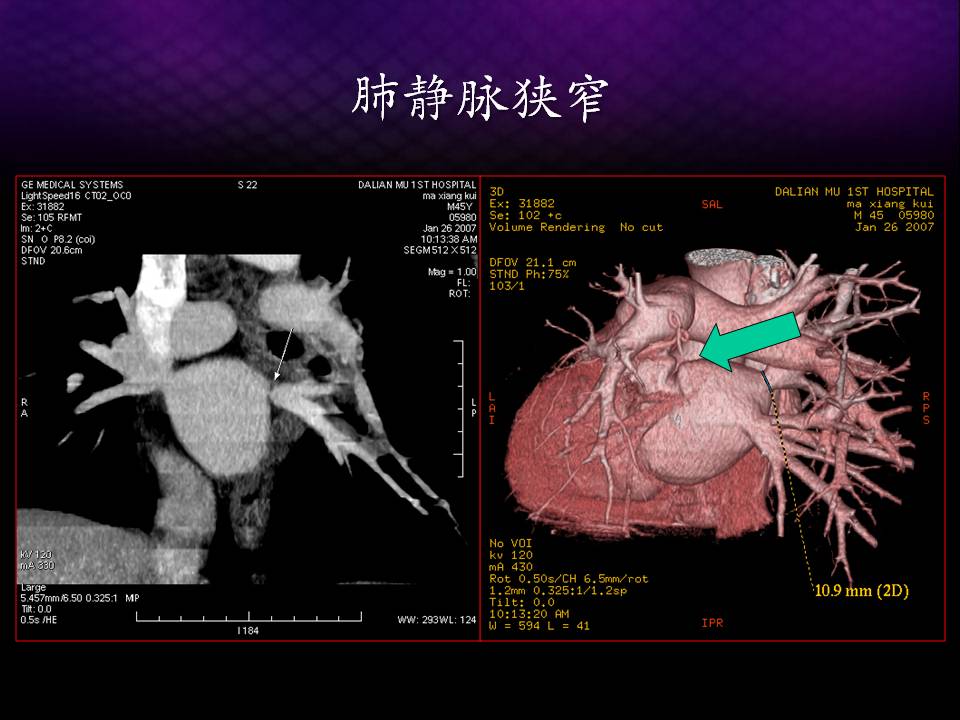 三维时代肺静脉狭窄的预防与处理