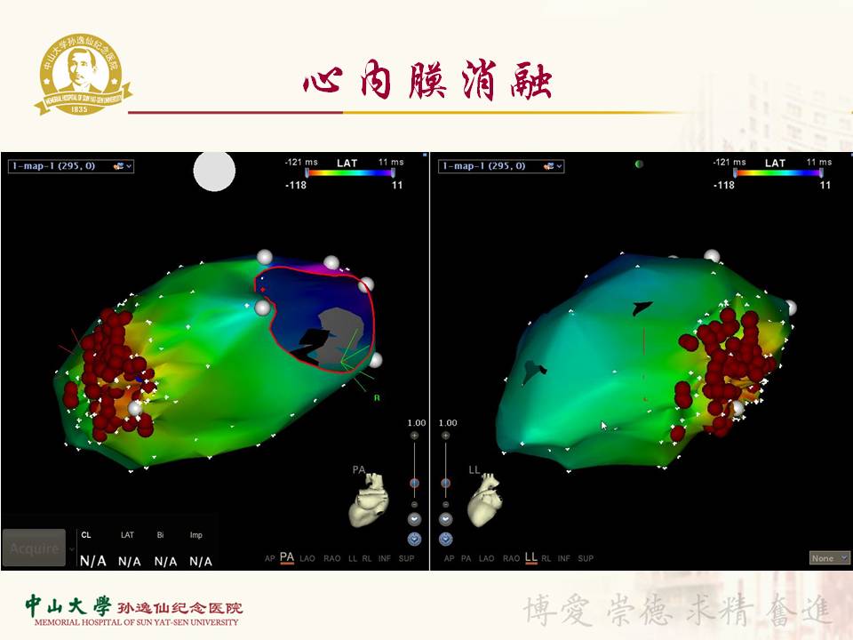 心外膜室速消融一例