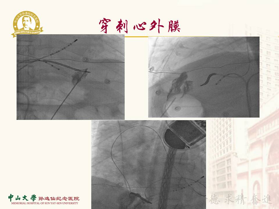 心外膜室速消融一例
