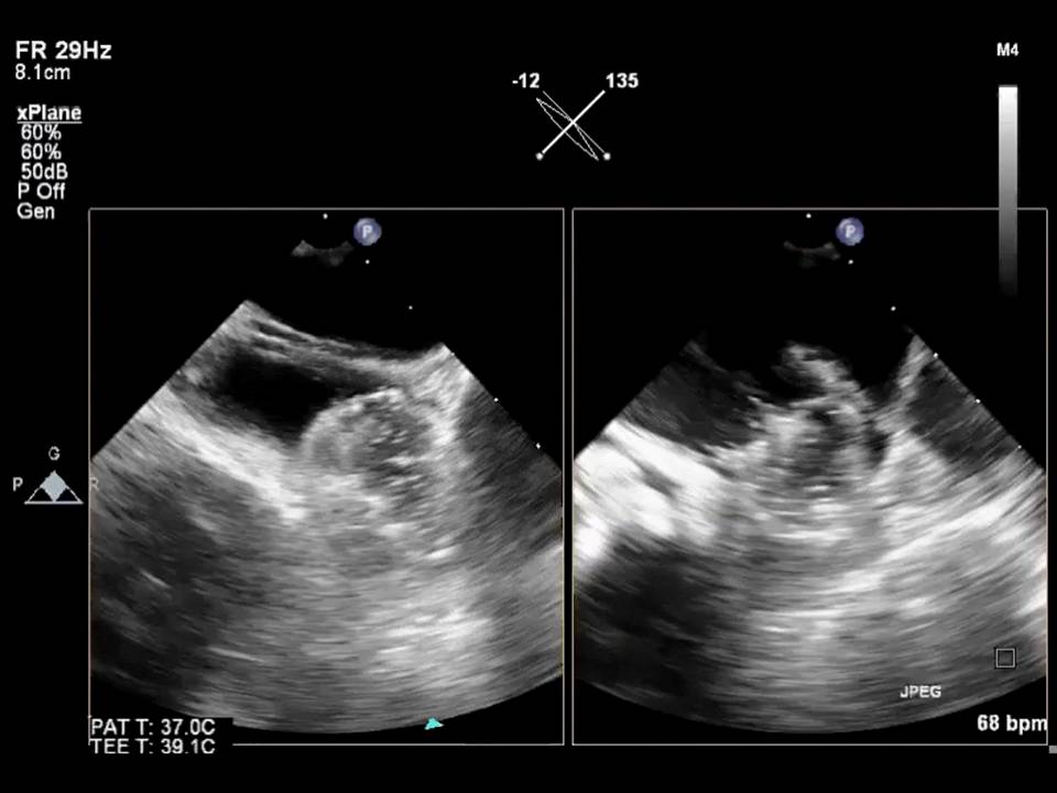 Application of ThreeDimensional Ultrasound in Left Atrial Appendage