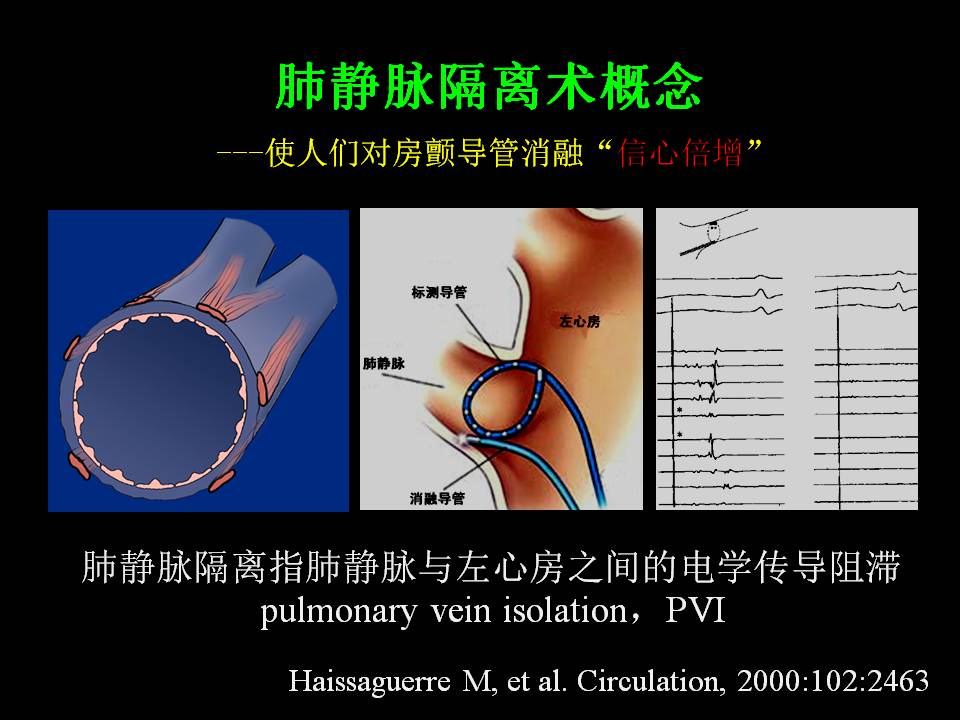 肺静脉隔离术难点