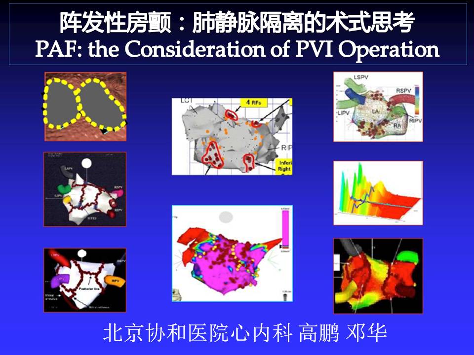 阵发性房颤:肺静脉隔离的术式思考