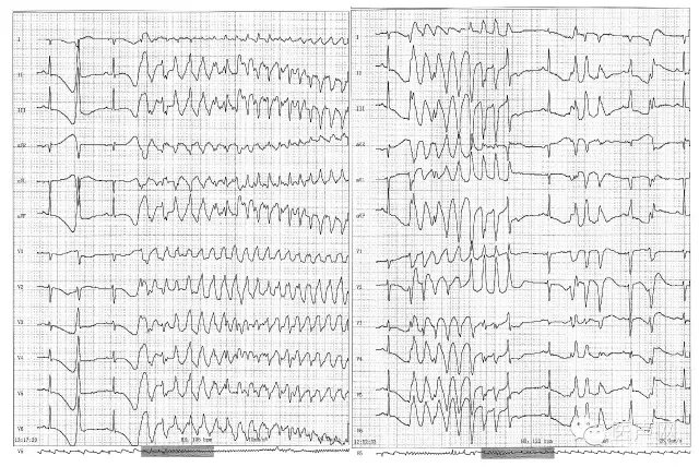 心脏猝死高危患者窦性心律的心电散点图特征