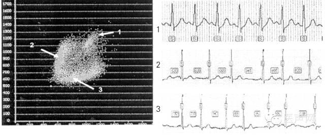 心律的整体观——认识和解读RR间期散点图