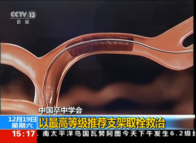 中国卒中学会：以最高等级推荐支架取栓救治