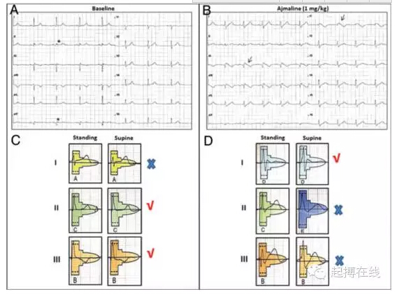 Brugada综合征患者阿义马林试验中重复形态分析很重要