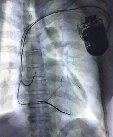 香港大学深圳医院心脏远程监护管理中心成立 暨深圳首台MPP左室多位点起搏CRT-D植入