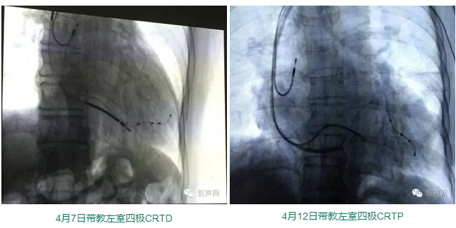 陕西CRT植入医生培训计划年中回顾