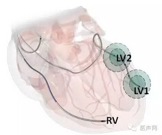 左室多位点起搏减少心脏再同步治疗远期室性早搏发生