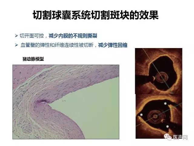 切割球囊联合药物球囊/心球联盟——复杂冠脉病变精锐研讨会第二站在京成功举行
