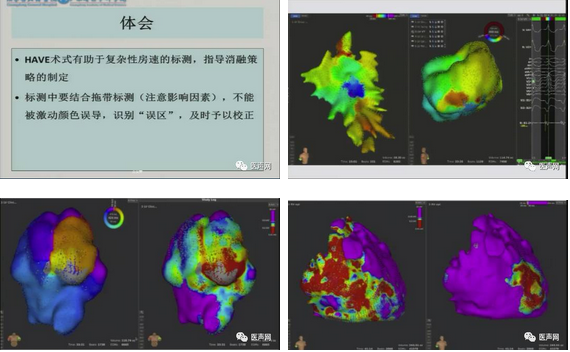 标精例益——Rhythmia高密度标测峰会全程回顾