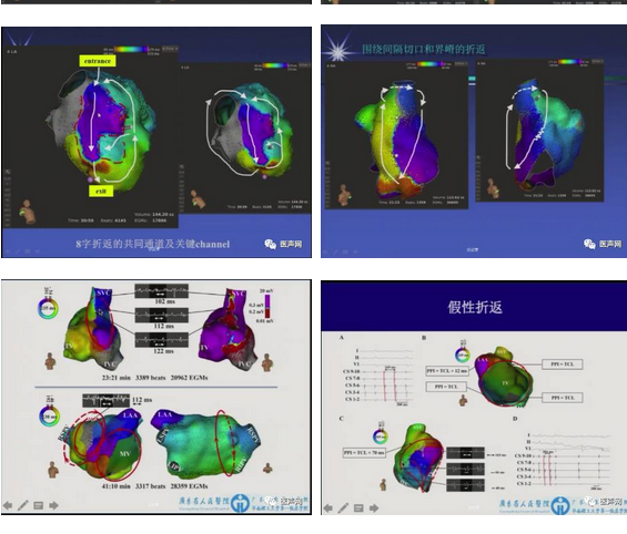 标精例益——Rhythmia高密度标测峰会全程回顾