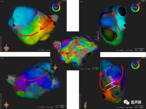 标精例益——Rhythmia高密度标测峰会全程回顾