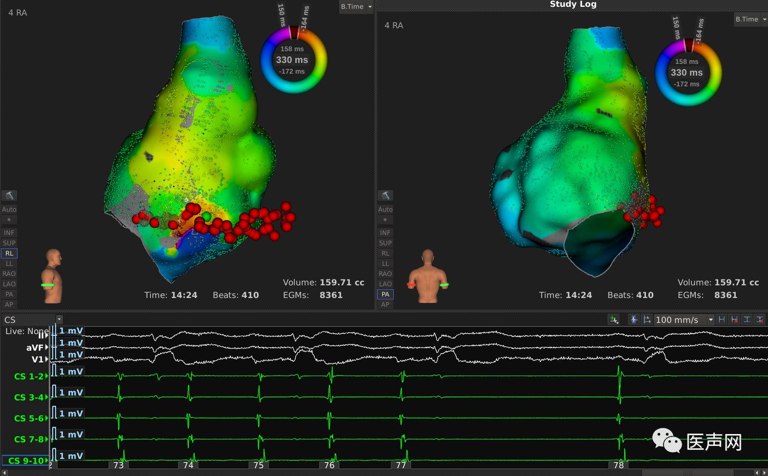 标精例益——Rhythmia高密度标测峰会全程回顾