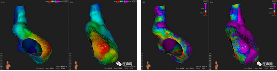 标精例益——Rhythmia高密度标测峰会全程回顾
