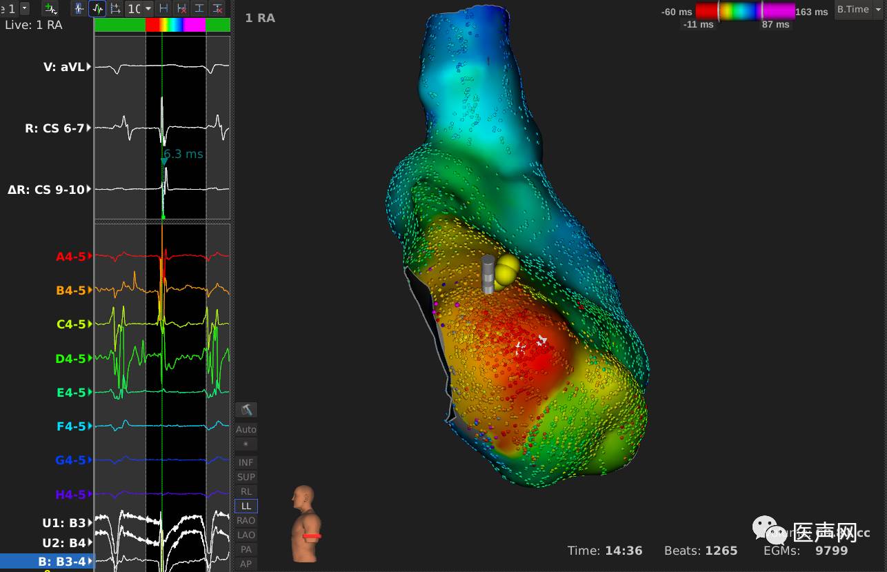 标精例益——Rhythmia高密度标测峰会全程回顾