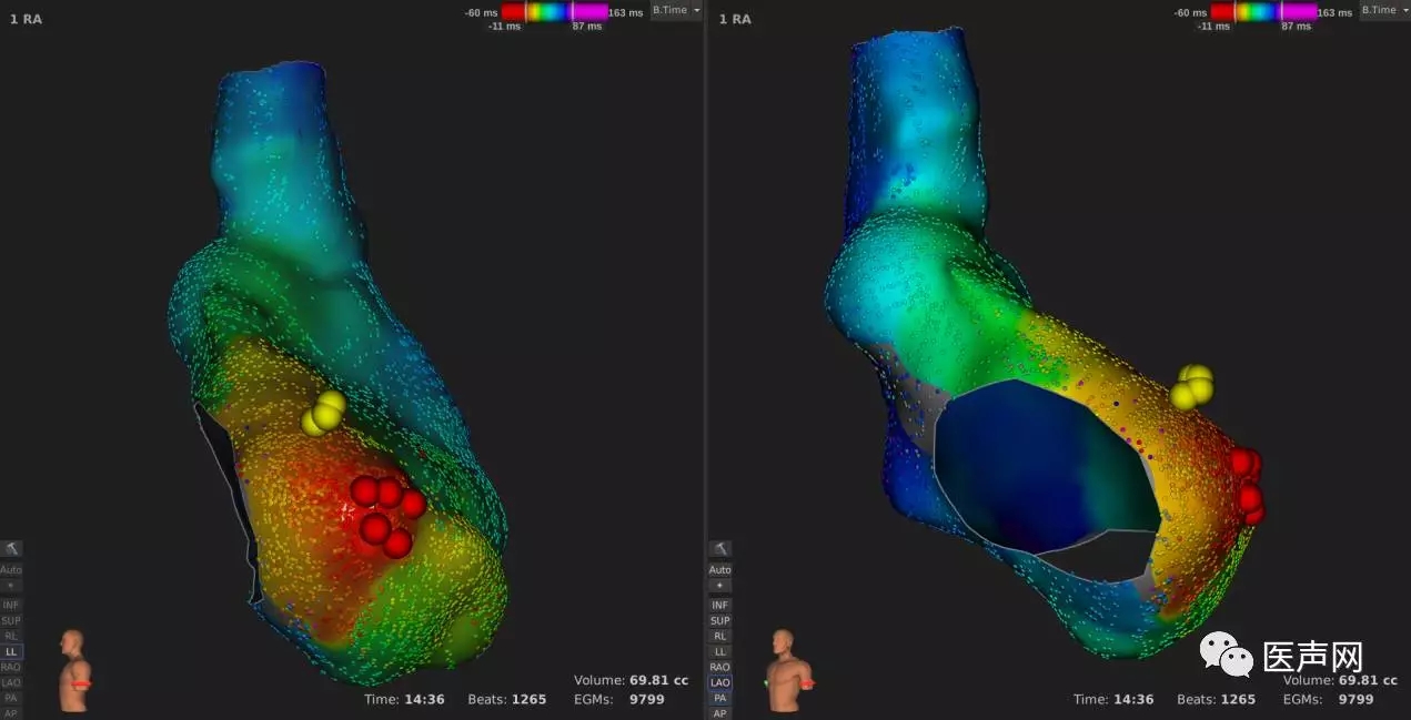 标精例益——Rhythmia高密度标测峰会全程回顾