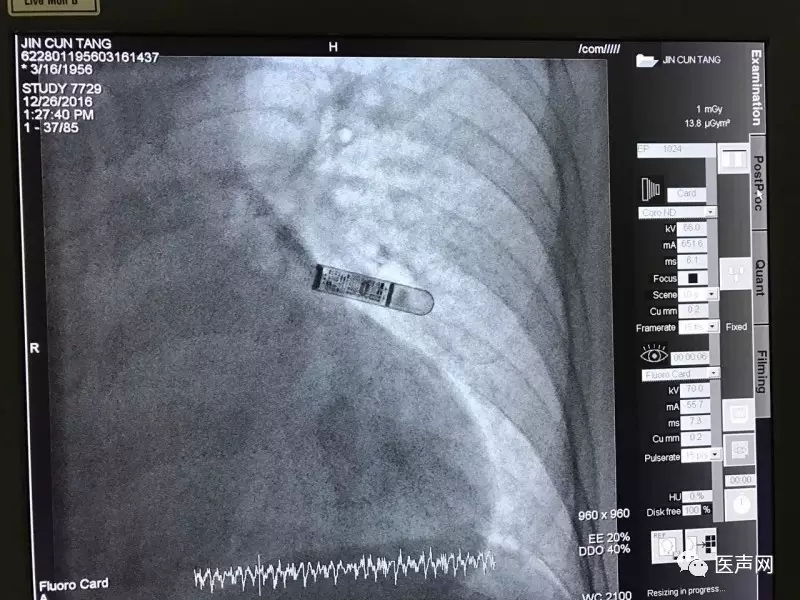 张钲:五年不适两次晕厥,植入Reveal LINQ明确诊断