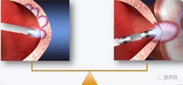 TactiCath™ Quartz光感应压力导管首批使用 受到我国专家一致好评