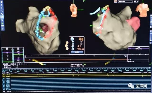 资讯 | 青海省人民医院成功完成西北地区首例应用光感压力导管消融阵发性房颤