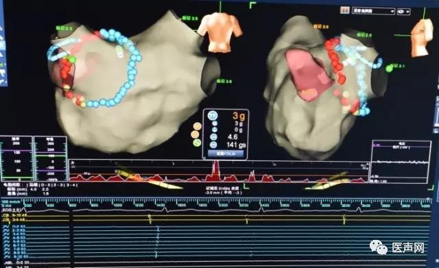 资讯 | 青海省人民医院成功完成西北地区首例应用光感压力导管消融阵发性房颤