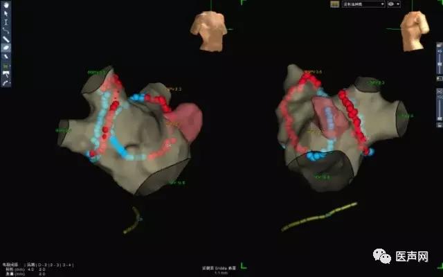 资讯 | 青海省人民医院成功完成西北地区首例应用光感压力导管消融阵发性房颤