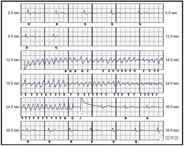 华伟：S-ICD——心脏性猝死预防的新篇章