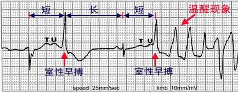 遗传性心律失常ICD治疗策略