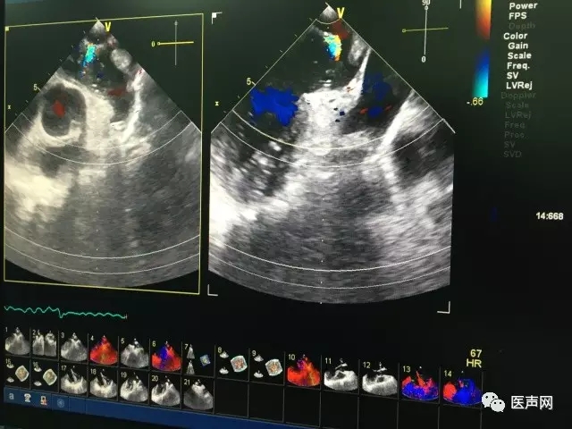 福建省立医院成功开展2例ACP左心耳封堵术