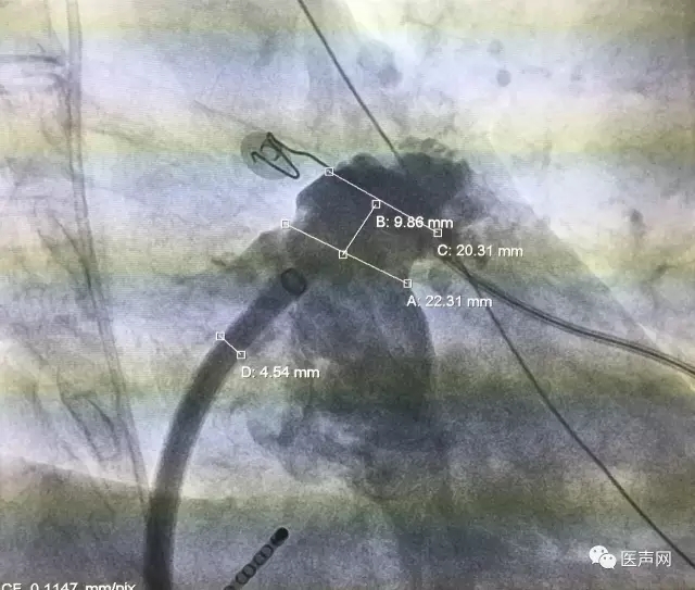 福建省立医院成功开展2例ACP左心耳封堵术