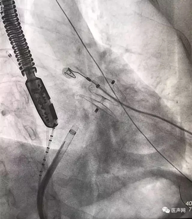 福建省立医院成功开展2例ACP左心耳封堵术