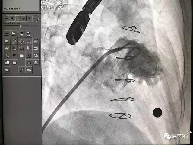福建省立医院成功开展2例ACP左心耳封堵术