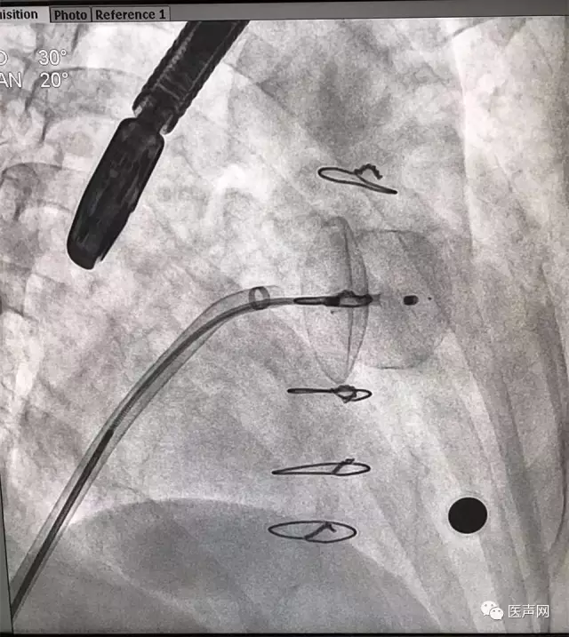 福建省立医院成功开展2例ACP左心耳封堵术