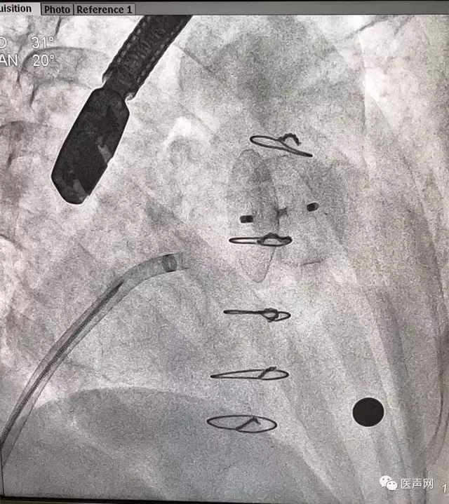 福建省立医院成功开展2例ACP左心耳封堵术