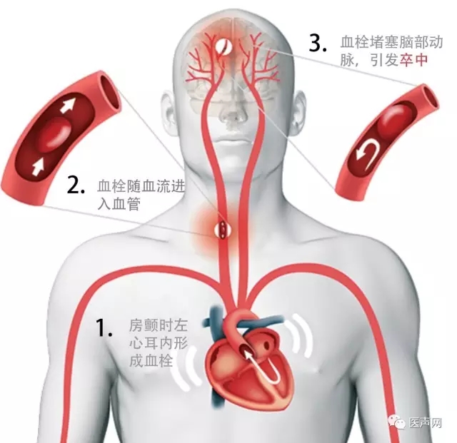 福建省立医院成功开展2例ACP左心耳封堵术
