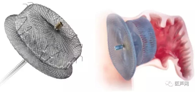 福建省立医院成功开展2例ACP左心耳封堵术