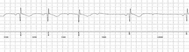 董颖雪:晕厥诊断的利器