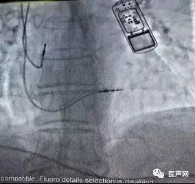 董颖雪:晕厥诊断的利器