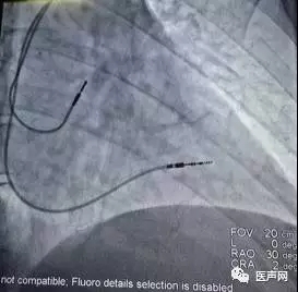 董颖雪:晕厥诊断的利器