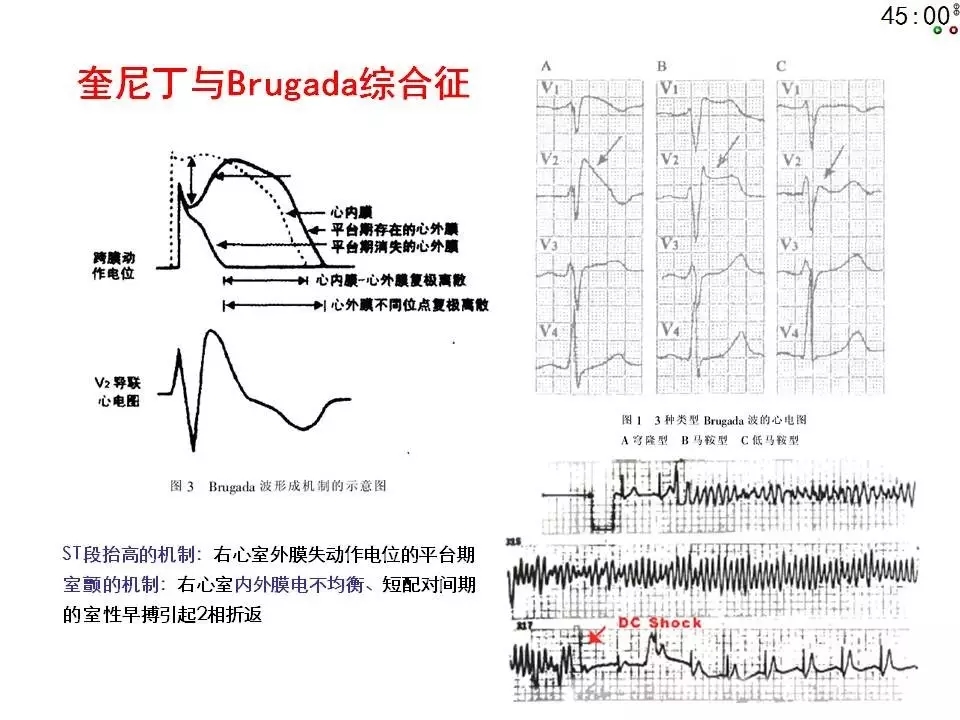 舒茂琴:抗心律失常药物临床应用——老药新用