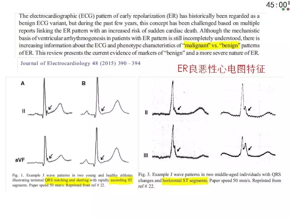 舒茂琴:抗心律失常药物临床应用——老药新用