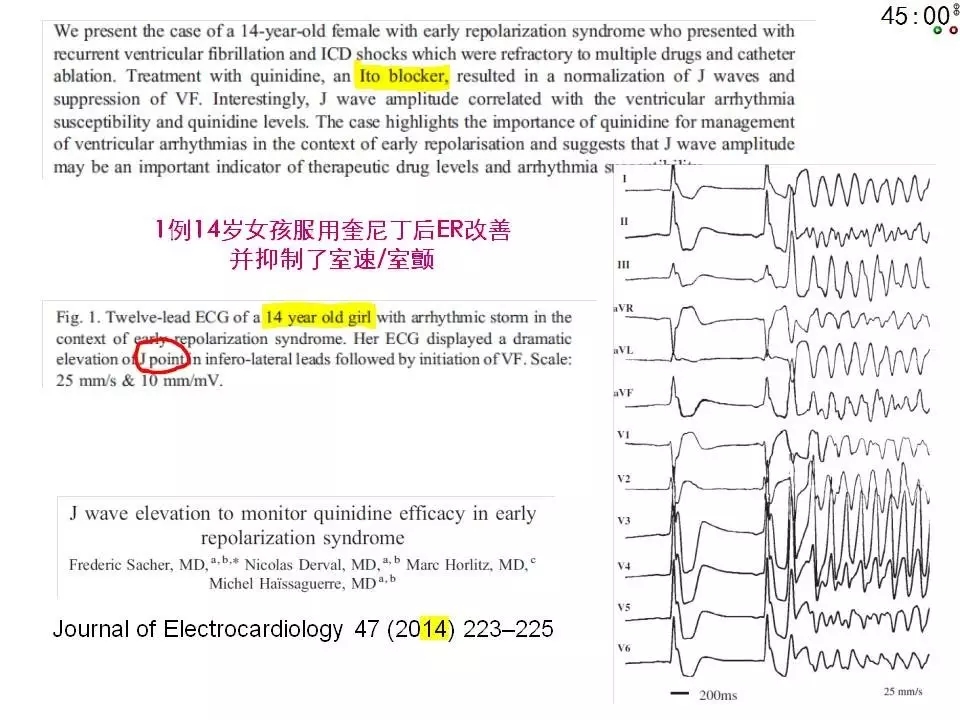 舒茂琴:抗心律失常药物临床应用——老药新用